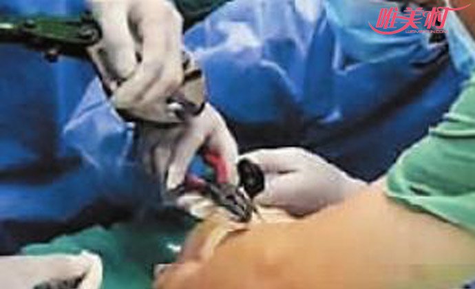 2歲女童眉骨戳進(jìn)剪刀 兇險經(jīng)過曝光女童疼痛到已麻木 2